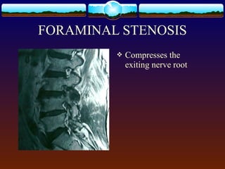  Compresses the
exiting nerve root
FORAMINAL STENOSIS
 