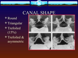 CANAL SHAPE
 Round
 Triangular
 Trefoiled
(15%)
 Trefoiled &
asymmetric
 