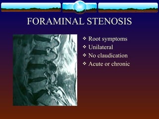  Root symptoms
 Unilateral
 No claudication
 Acute or chronic
FORAMINAL STENOSIS
 