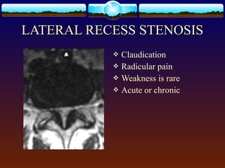  Claudication
 Radicular pain
 Weakness is rare
 Acute or chronic
LATERAL RECESS STENOSISLATERAL RECESS STENOSIS
 