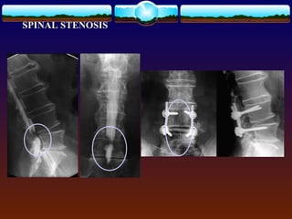 SPINAL STENOSIS
 