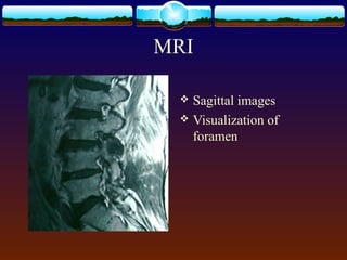 MRI
 Sagittal images
 Visualization of
foramen
 