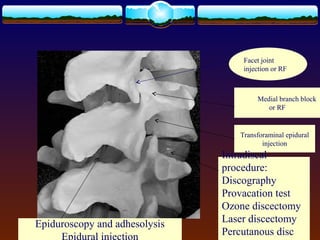 Facet joint
injection or RF
Medial branch block
or RF
Transforaminal epidural
injection
Intradiscal
procedure:
Discography
Provacation test
Ozone discectomy
Laser discectomy
Percutanous disc
Epiduroscopy and adhesolysis
Epidural injection
 