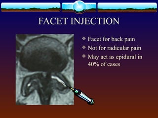 FACET INJECTION
 Facet for back pain
 Not for radicular pain
 May act as epidural in
40% of cases
 