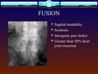 FUSION
 Sagittal instability
 Scoliosis
 Iatrogenic pars defect
 Greater than 50% facet
joint resection
 