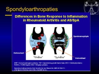 Spondyloarthropaties
 