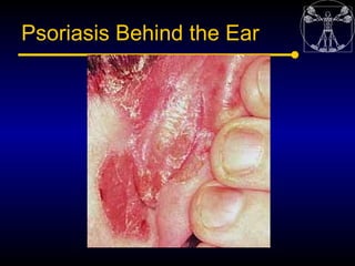 Psoriasis Behind the Ear
 