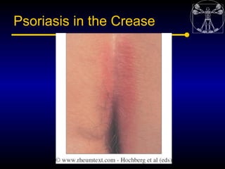 Psoriasis in the Crease
 