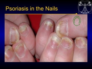 Psoriasis in the Nails
 