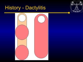 History - Dactylitis
 