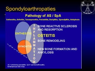 Spondyloarthropaties
 