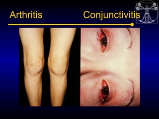 Arthritis   Conjunctivitis
 