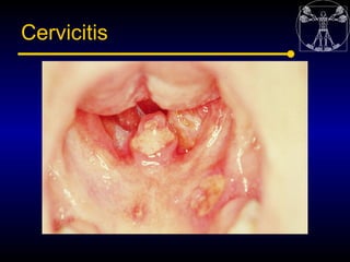 Cervicitis
 