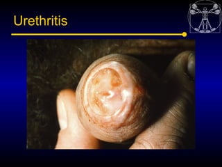 Urethritis
 