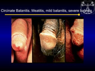 Circinate Balanitis. Meatitis, mild balanitis, severe balinitis
 