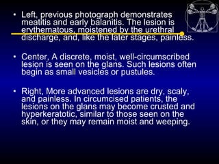• Left, previous photograph demonstrates
  meatitis and early balanitis. The lesion is
  erythematous, moistened by the ur...