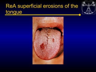 ReA superficial erosions of the
tongue
 