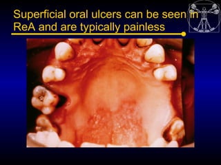 Superficial oral ulcers can be seen in
ReA and are typically painless
 