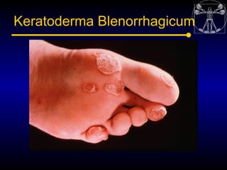 Keratoderma Blenorrhagicum
 