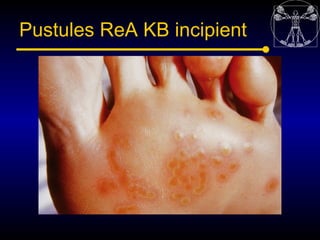 Pustules ReA KB incipient
 