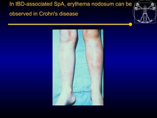 In IBD-associated SpA, erythema nodosum can be
observed in Crohn's disease
 