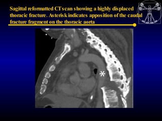 Sagittal reformatted CTscan showing a highly displaced
thoracic fracture. Asterisk indicates apposition of the caudal
frac...