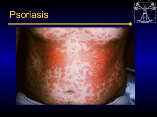 Psoriasis
 