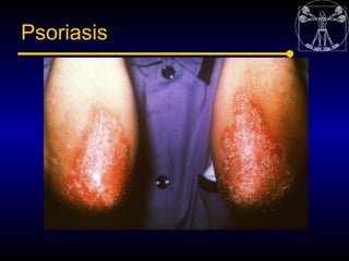 Psoriasis
 