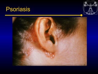 Psoriasis
 