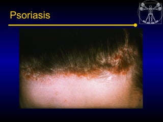 Psoriasis
 