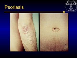 Psoriasis
 