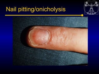 Nail pitting/onicholysis
 
