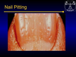 Nail Pitting
 