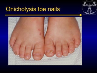 Onicholysis toe nails
 