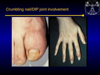 Crumbling nail/DIP joint involvement
 