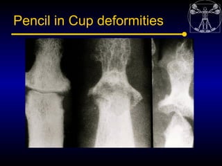 Pencil in Cup deformities
 