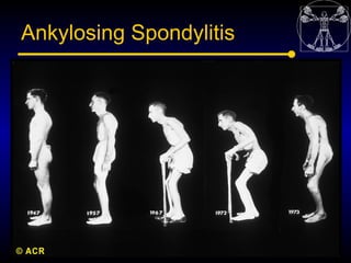 Ankylosing Spondylitis
 