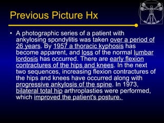 Previous Picture Hx
• A photographic series of a patient with
  ankylosing spondylitis was taken over a period of
  26 yea...