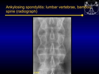 Ankylosing spondylitis: lumbar vertebrae, bamboo
spine (radiograph)
 