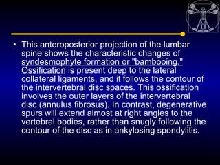 • This anteroposterior projection of the lumbar
  spine shows the characteristic changes of
  syndesmophyte formation or "...