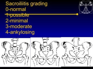 Sacroiliitis grading
0-normal
1-possible
2-minimal
3-moderate
4-ankylosing
 