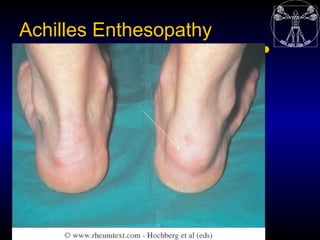 Achilles Enthesopathy
 