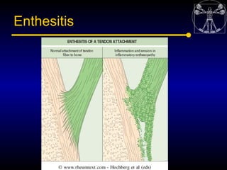 Enthesitis
 