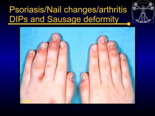 Psoriasis/Nail changes/arthritis
DIPs and Sausage deformity
 