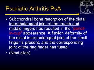 Psoriatic Arthritis PsA
• Subchondral bone resorption of the distal
  interphalangeal joint of the thumb and
  middle fing...
