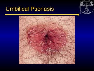 Umbilical Psoriasis
 