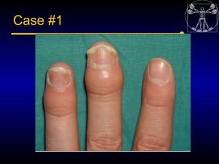 5spondyloarthropaties Seronegative Arthritis