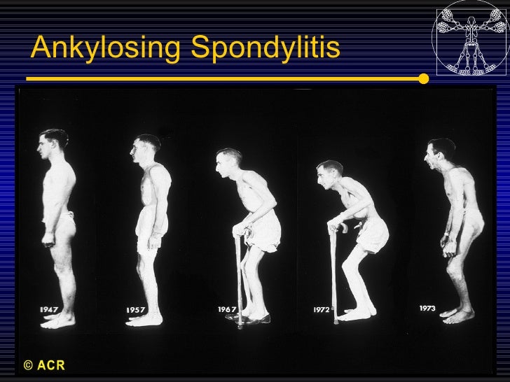 5spondyloarthropaties Seronegative Arthritis