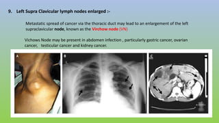 9. Left Supra Clavicular lymph nodes enlarged :-
Metastatic spread of cancer via the thoracic duct may lead to an enlargement of the left
supraclavicular node, known as the Virchow node (VN)
Vichows Node may be present in abdomen infection , particularly gastric cancer, ovarian
cancer, testicular cancer and kidney cancer.
 