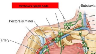 Virchow's lymph node
 